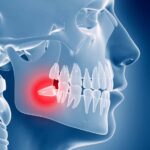 Extrações dos dentes sisos