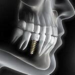 Implantes Dentários